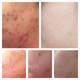 Illustration for article titled Hormonal Acne: My Gross Progression